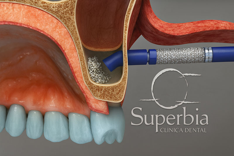injerto Dr. Facundo, odontólogo de Clínica Dental Superbía en Tenerife